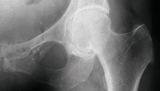 Arthroplastik