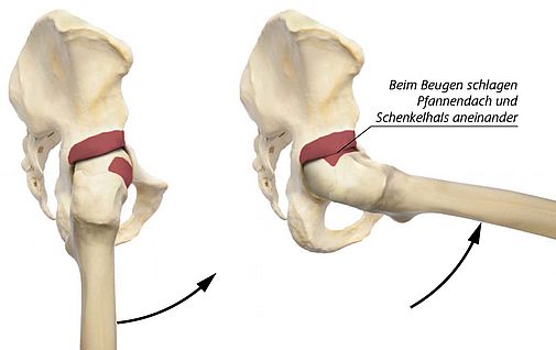Bewegungseinschränkung beim Impingement