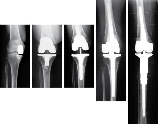 Tep Knie 141212