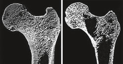 Osteoporose